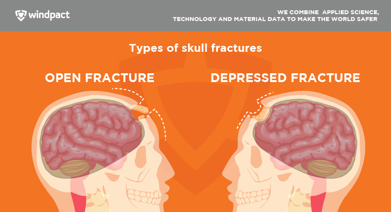 types of skull fracture